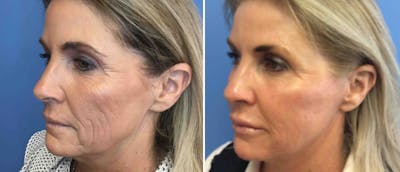 Laser Skin Rejuvenation Before & After Gallery - Patient 38566923 - Image 1