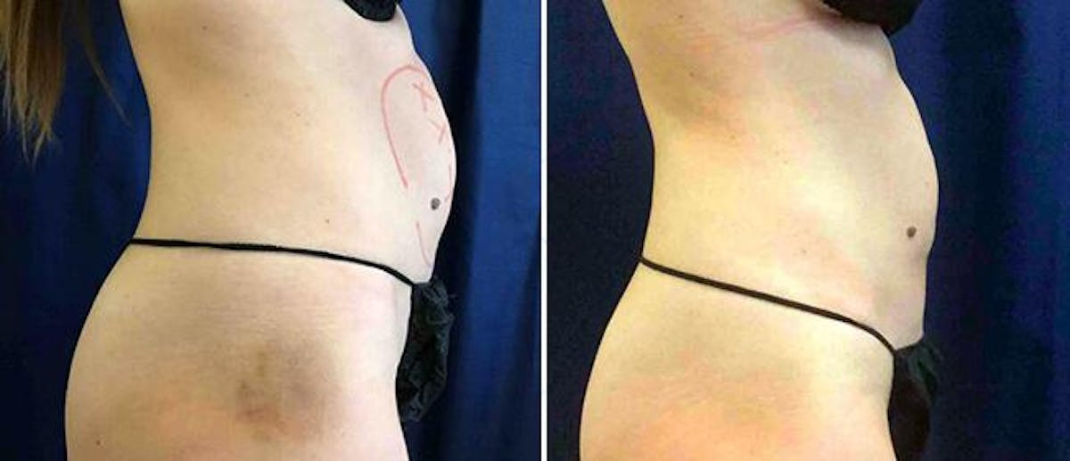 Coolsculpting Before & After Gallery - Patient 38566922 - Image 1