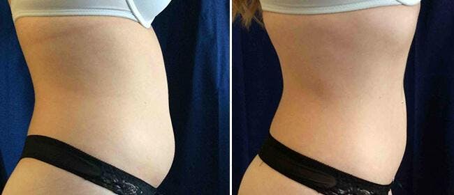 Coolsculpting Before & After Gallery - Patient 38566925 - Image 1