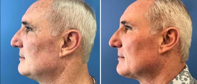 Laser Skin Rejuvenation Before & After Gallery - Patient 38566927 - Image 1