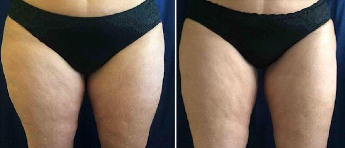 Coolsculpting Before & After Gallery - Patient 38566928 - Image 1