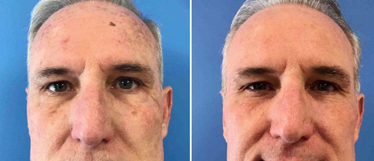 Laser Skin Rejuvenation Before & After Gallery - Patient 38566927 - Image 2