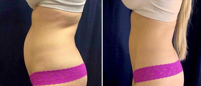 Coolsculpting Before & After Gallery - Patient 38566931 - Image 1