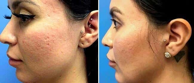 Laser Skin Rejuvenation Before & After Gallery - Patient 38566930 - Image 1