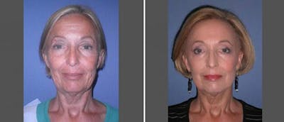 Laser Skin Rejuvenation Before & After Gallery - Patient 38566932 - Image 1