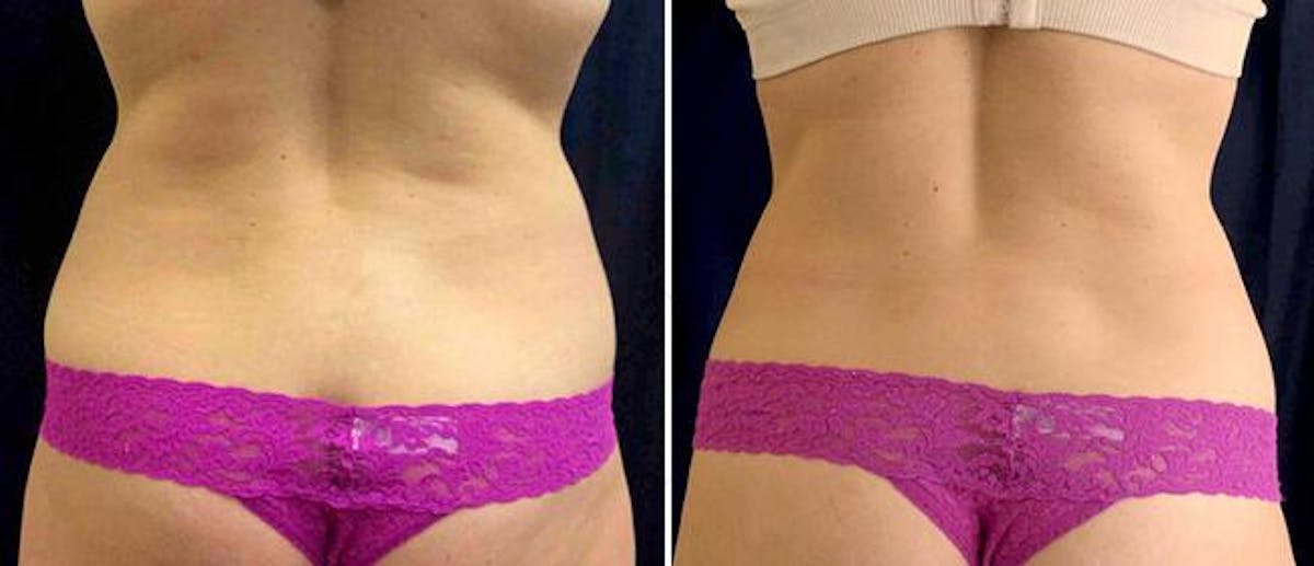 Coolsculpting Before & After Gallery - Patient 38566931 - Image 2