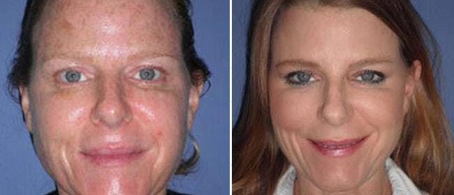 Laser Skin Rejuvenation Before & After Gallery - Patient 38566934 - Image 1