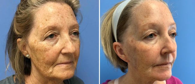 Laser Skin Tightening Before & After Gallery - Patient 38566935 - Image 1