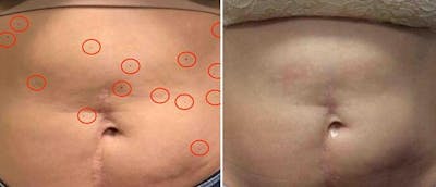 Laser Skin Rejuvenation Before & After Gallery - Patient 38566936 - Image 1