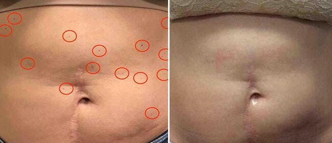 Laser Skin Rejuvenation Before & After Gallery - Patient 38566936 - Image 1