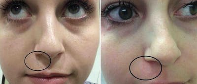 Laser Skin Rejuvenation Before & After Gallery - Patient 38566939 - Image 1
