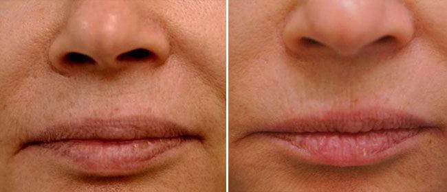 Laser Skin Tightening Before & After Gallery - Patient 38566942 - Image 1