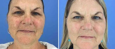 Laser Skin Rejuvenation Before & After Gallery - Patient 38566941 - Image 1