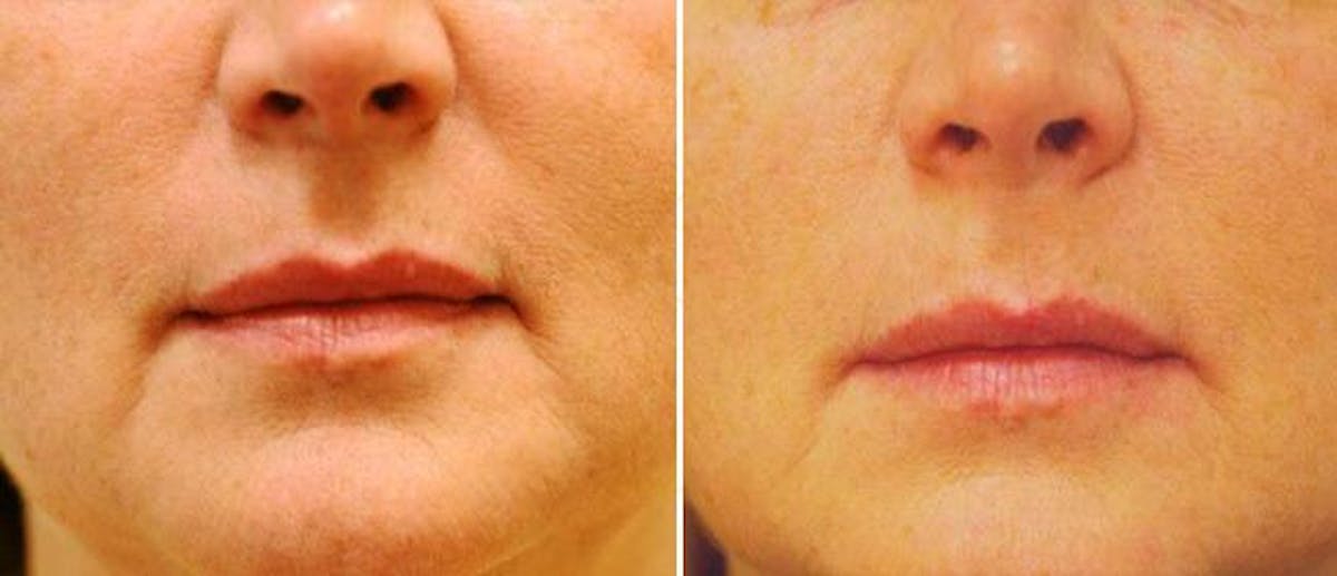 Laser Skin Tightening Before & After Gallery - Patient 38566944 - Image 1