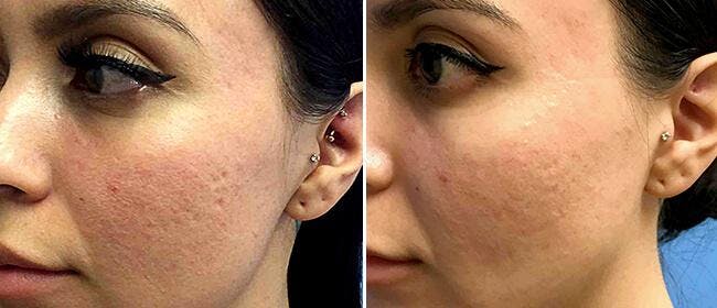 Laser Skin Rejuvenation Before & After Gallery - Patient 38566943 - Image 1