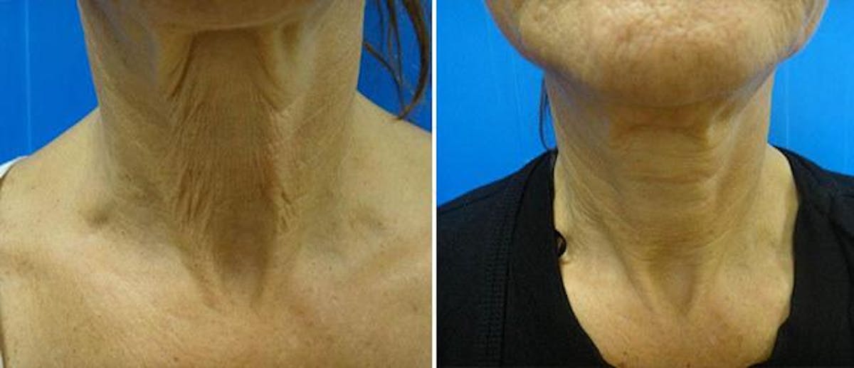 Laser Skin Tightening Before & After Gallery - Patient 38566946 - Image 1