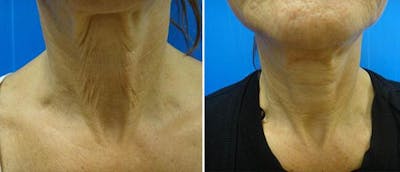Laser Skin Tightening Before & After Gallery - Patient 38566946 - Image 1