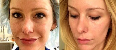 Laser Skin Rejuvenation Before & After Gallery - Patient 38566945 - Image 1