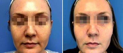 Laser Skin Rejuvenation Before & After Gallery - Patient 38566948 - Image 1