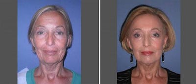 Laser Skin Tightening Before & After Gallery - Patient 38566947 - Image 1