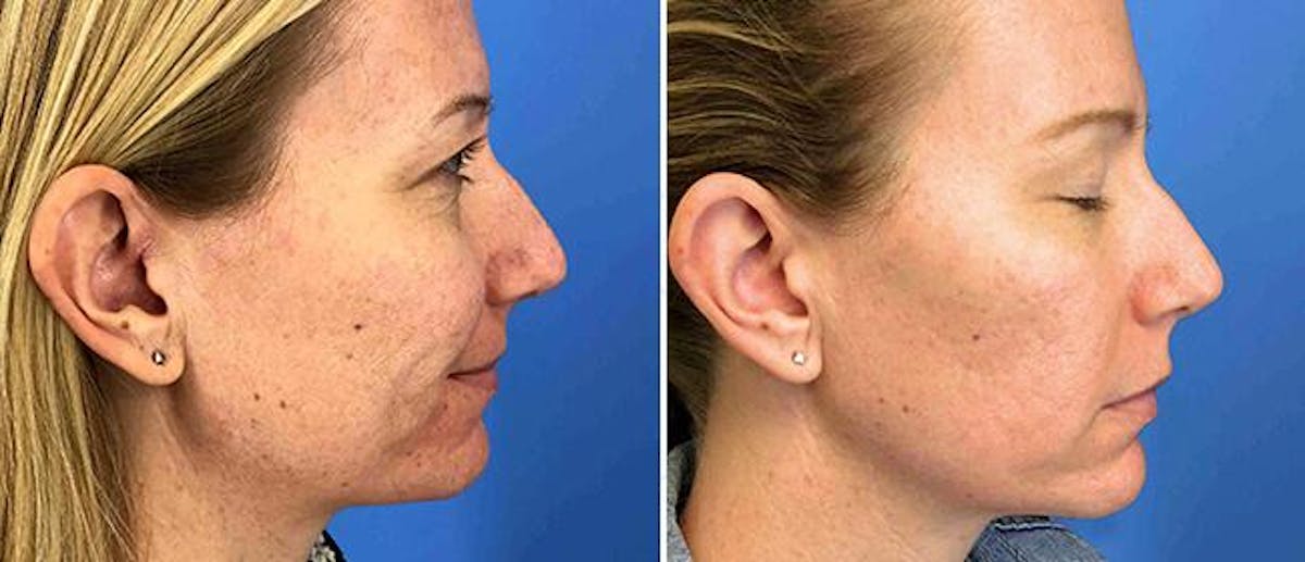 Laser Skin Rejuvenation Before & After Gallery - Patient 38566949 - Image 1