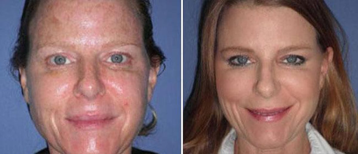 Laser Skin Rejuvenation Before & After Gallery - Patient 38566951 - Image 1