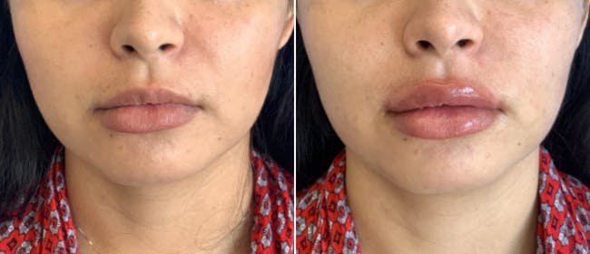 Lip Filler Before & After Gallery - Patient 38566952 - Image 1