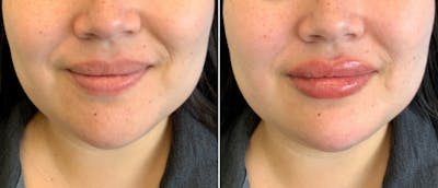Lip Filler Before & After Gallery - Patient 38566953 - Image 1