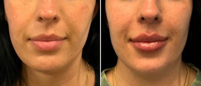 Lip Filler Before & After Gallery - Patient 38566954 - Image 1
