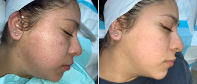 Micro-Needling Before & After Gallery - Patient 38566955 - Image 1