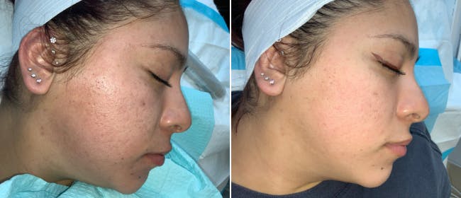 Micro-Needling Before & After Gallery - Patient 38566955 - Image 1