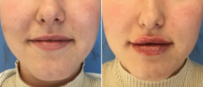Lip Filler Before & After Gallery - Patient 38566956 - Image 1