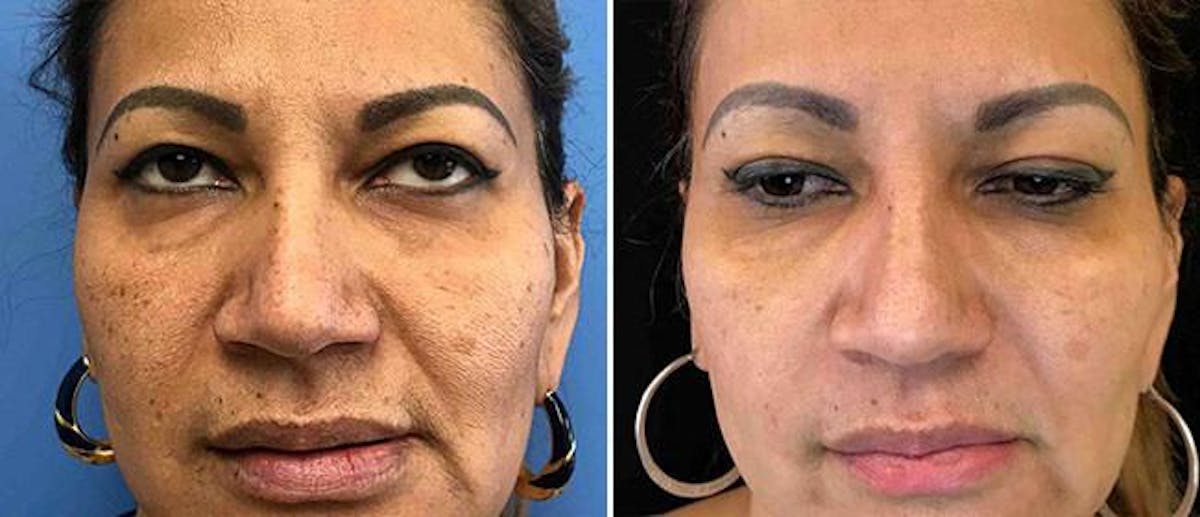 Micro-Needling Before & After Gallery - Patient 38566957 - Image 1