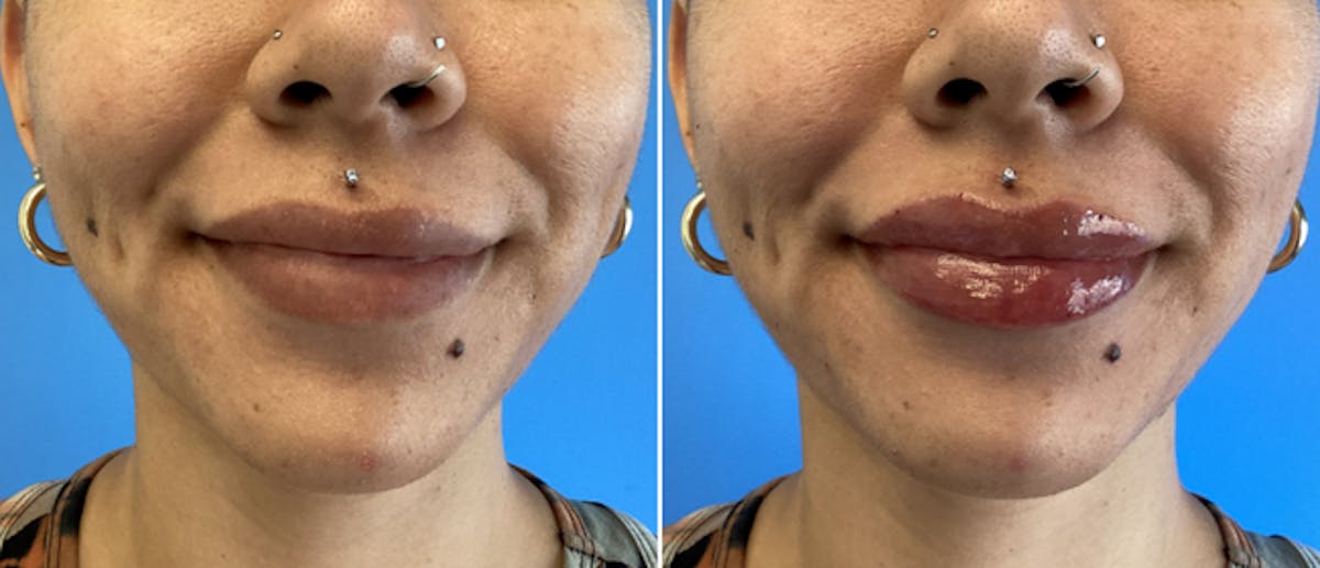 Lip Filler Before & After Gallery - Patient 38566959 - Image 1