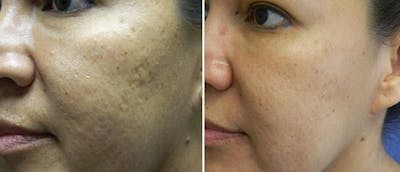 Micro-Needling Before & After Gallery - Patient 38566960 - Image 1