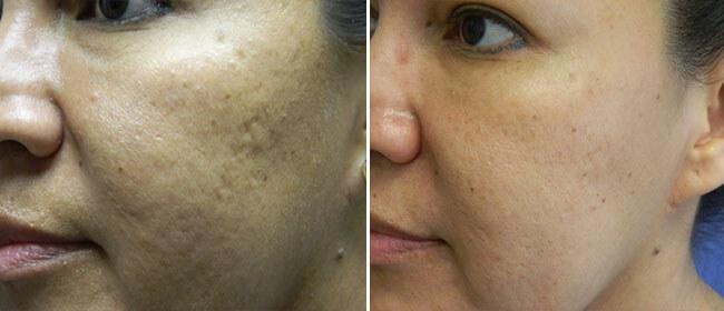 Micro-Needling Before & After Gallery - Patient 38566960 - Image 1