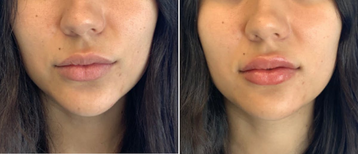 Lip Filler Before & After Gallery - Patient 38569112 - Image 1