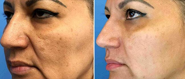 Micro-Needling Before & After Gallery - Patient 38569113 - Image 1