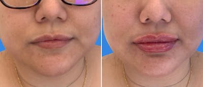 Lip Filler Before & After Gallery - Patient 38569119 - Image 1