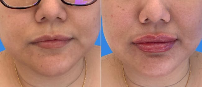Lip Filler Before & After Gallery - Patient 38569119 - Image 1