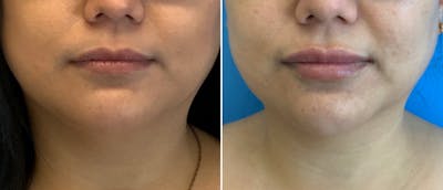 Lip Filler Before & After Gallery - Patient 38569120 - Image 1