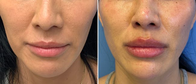 Lip Filler Before & After Gallery - Patient 38569121 - Image 1