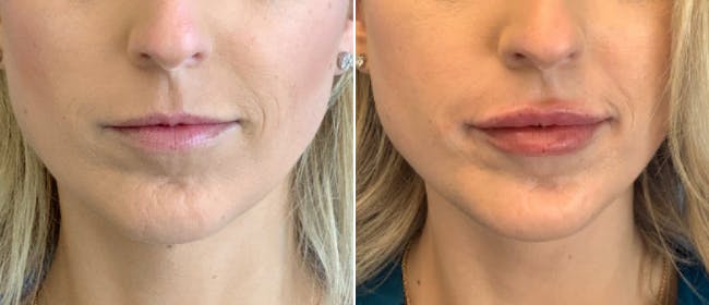 Lip Filler Before & After Gallery - Patient 38569122 - Image 1