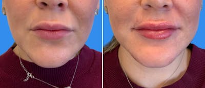 Lip Filler Before & After Gallery - Patient 38569124 - Image 1