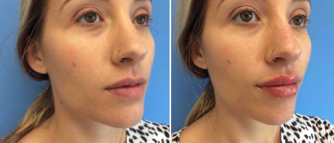 Lip Filler Before & After Gallery - Patient 38569126 - Image 1