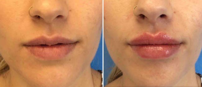 Lip Filler Before & After Gallery - Patient 38569126 - Image 2