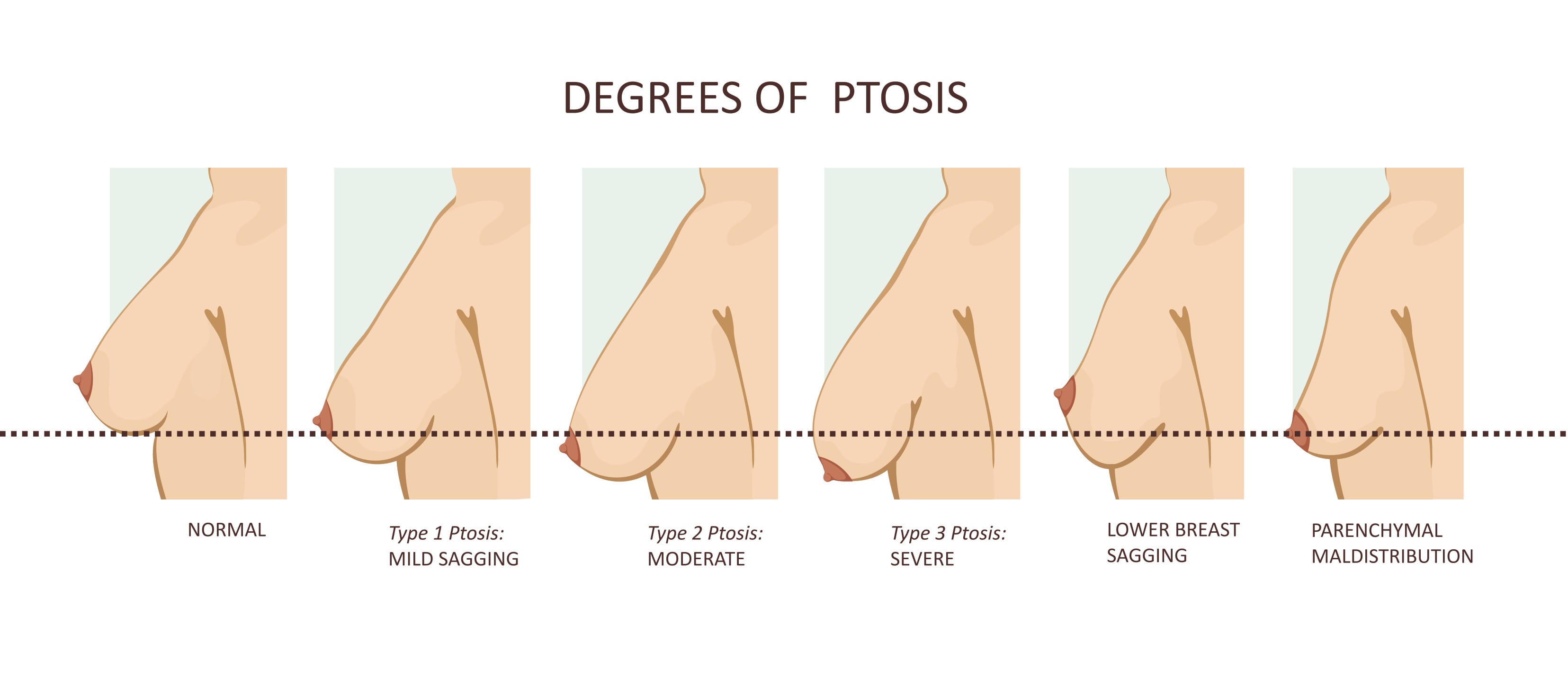 Infographic of the Degrees of Ptosis