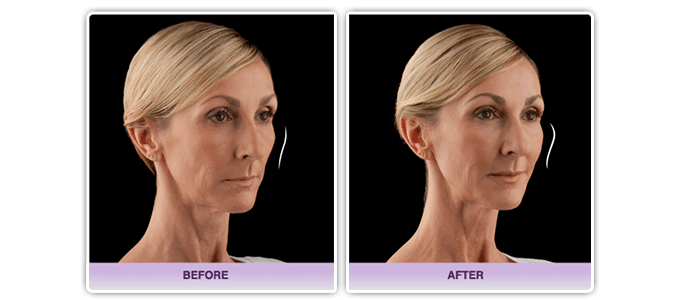 JUVEDERM VOLUMA XC Example