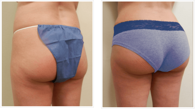 nicki minaj butt butt lift butt injections 