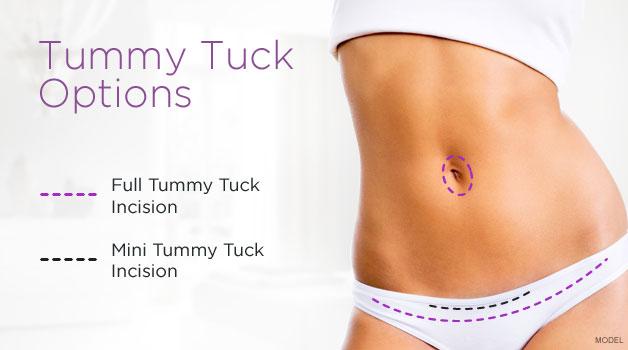 Causes and Solutions for FUPA (Fat Fat Upper Pubic Area) - Anca Breahna  Plastic Surgeon